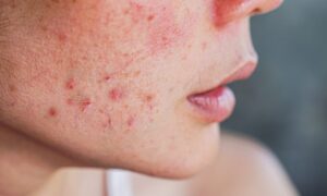 Acne: profissional da Unesc explica causas, efeitos e tratamentos eficazes