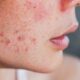 Acne: profissional da Unesc explica causas, efeitos e tratamentos eficazes