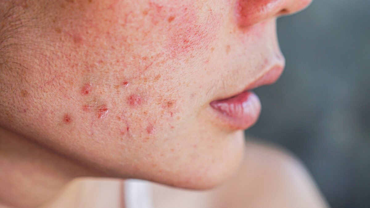 Acne: profissional da Unesc explica causas, efeitos e tratamentos eficazes